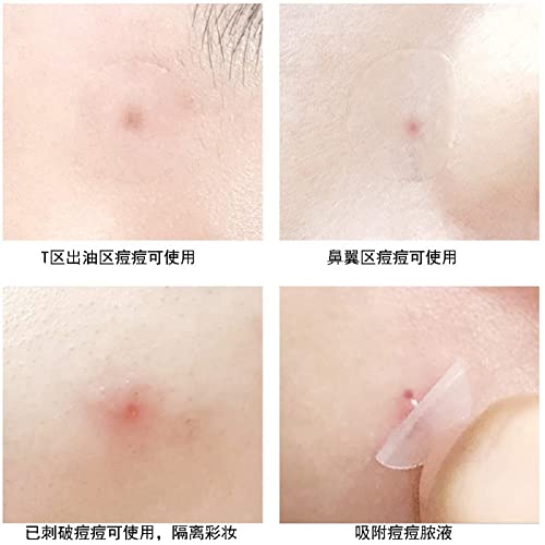 Acne patch remover acne patch hydrocolloid acne patch dan i noć Acne clearing patch nevidljivi