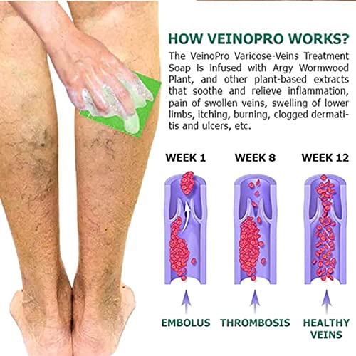 Varikozne vene tretman za noge-varikozne vene sapun, uklanjanje Spider vene tretman za noge ljekovita