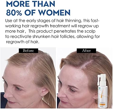 Sprej za rast kose protiv opadanja kose esencijalno ulje tečnost za muškarce žene regeneracija kose